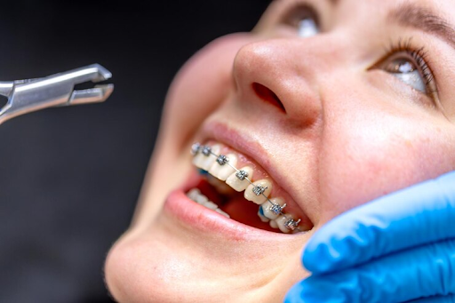 Smarter Smiles: Why Self-Ligating Braces Are the Future of Orthodontics in Singapore