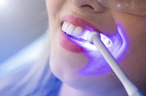 Professional Teeth Whitening Colorado Springs